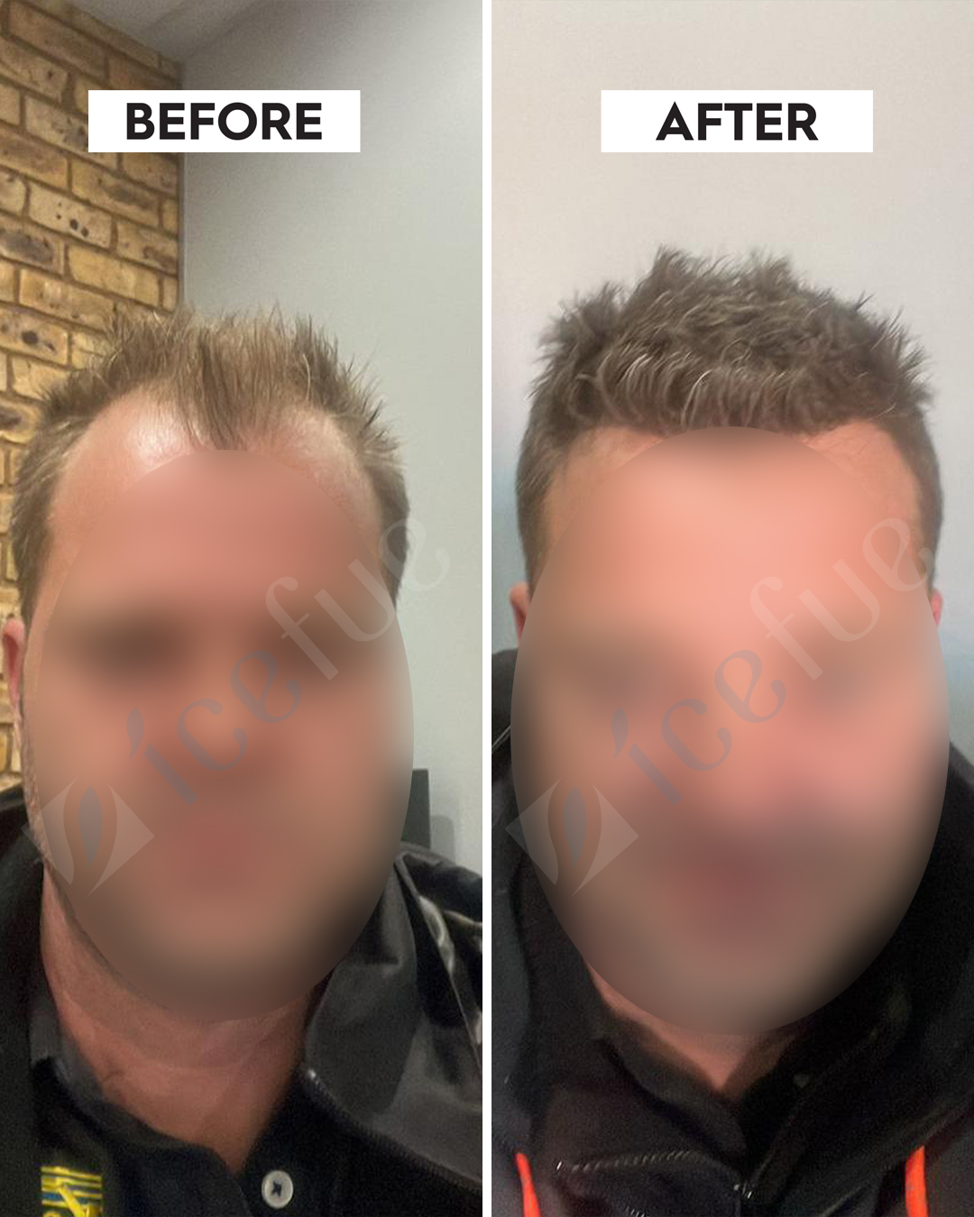 Hair Transplant Result 1
