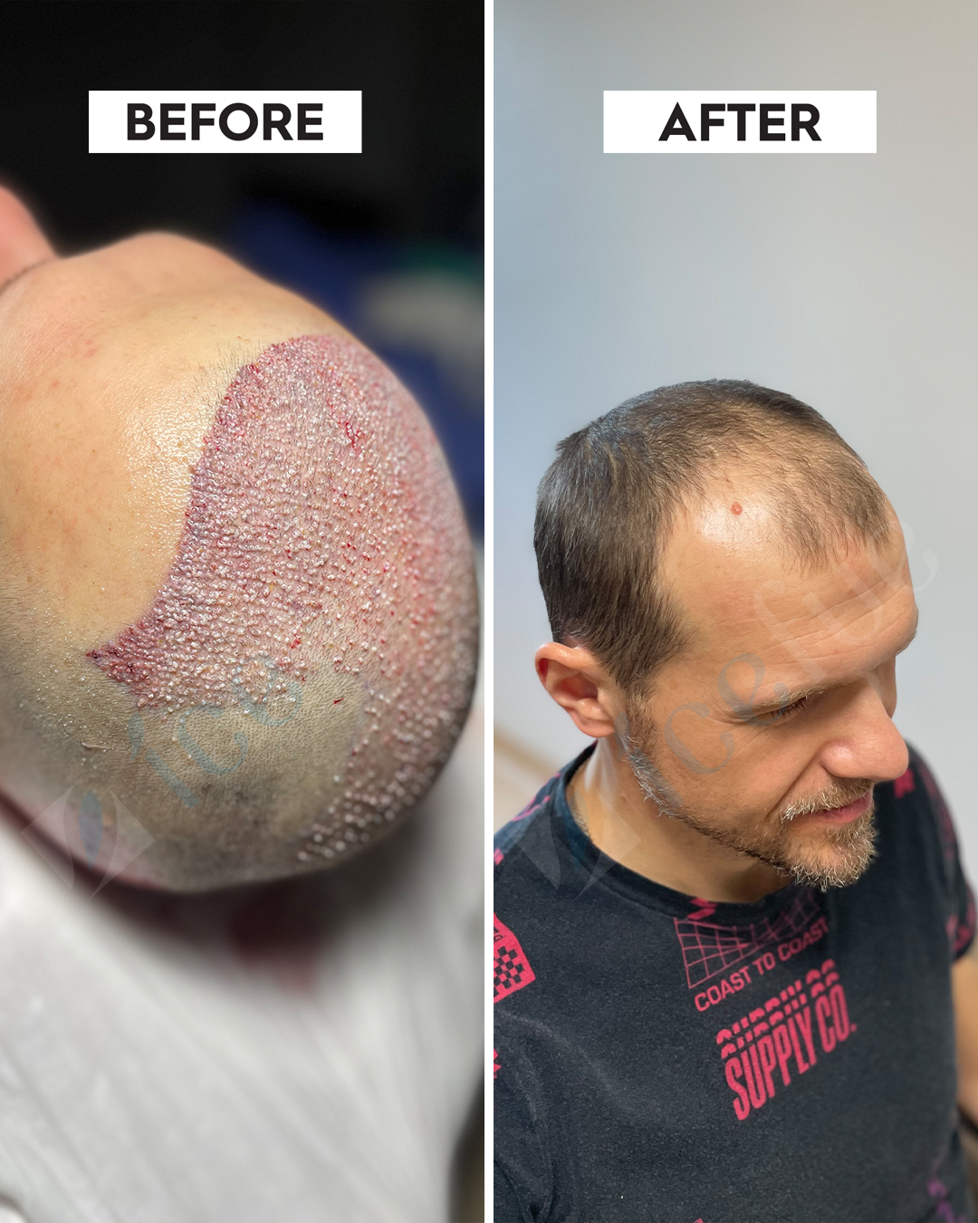 Hair Transplant Result 10