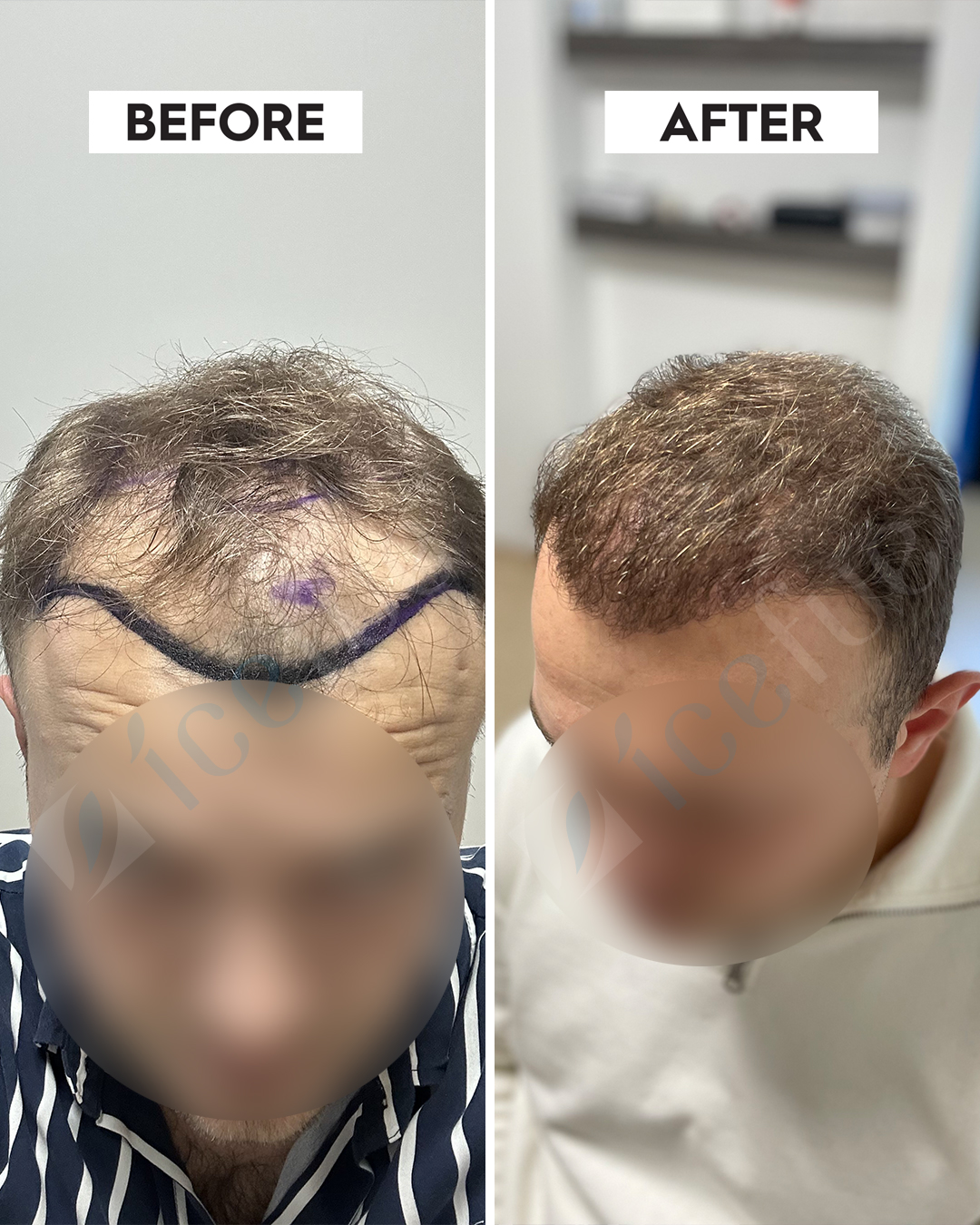 Hair Transplant Result 11