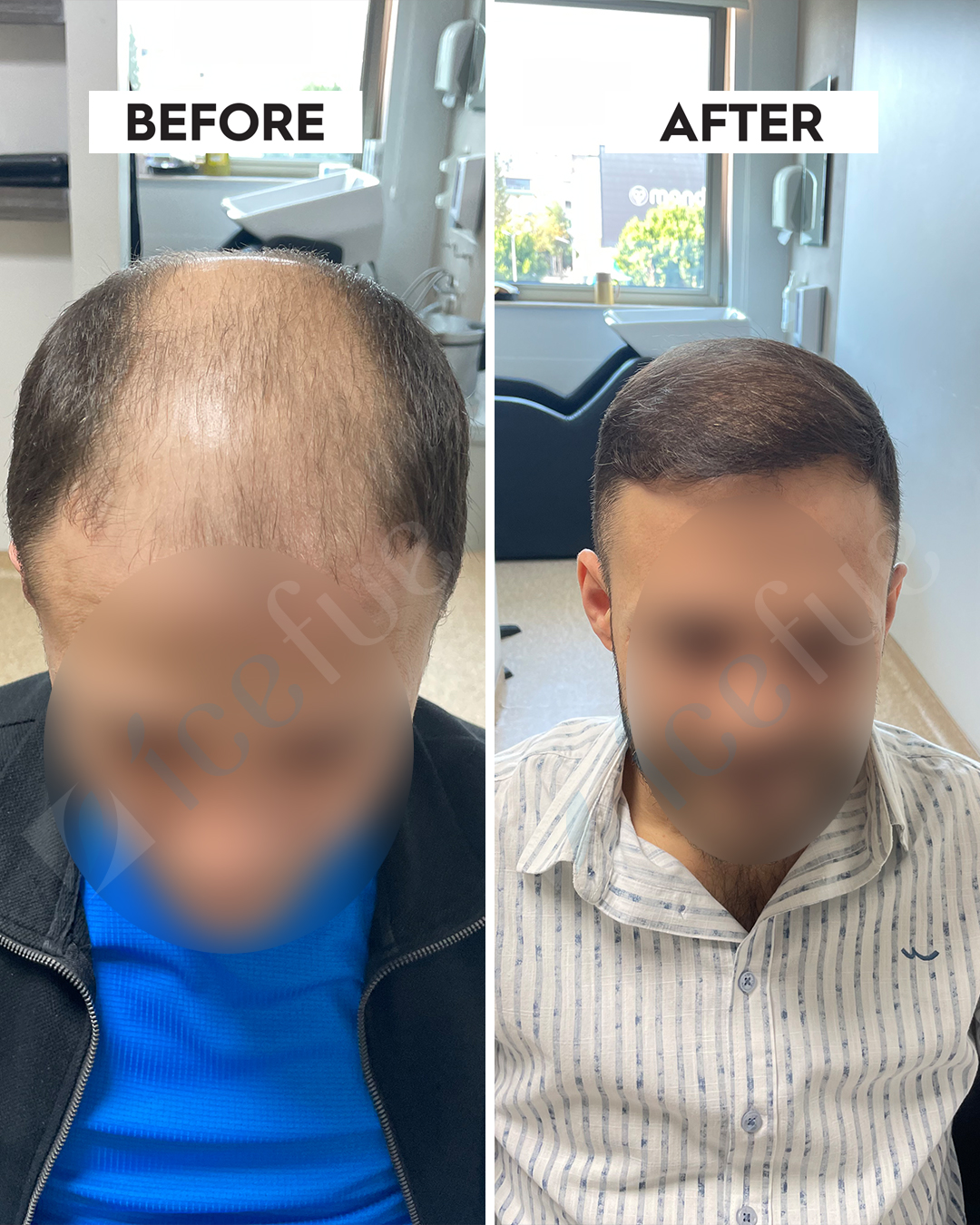 Hair Transplant Result 12