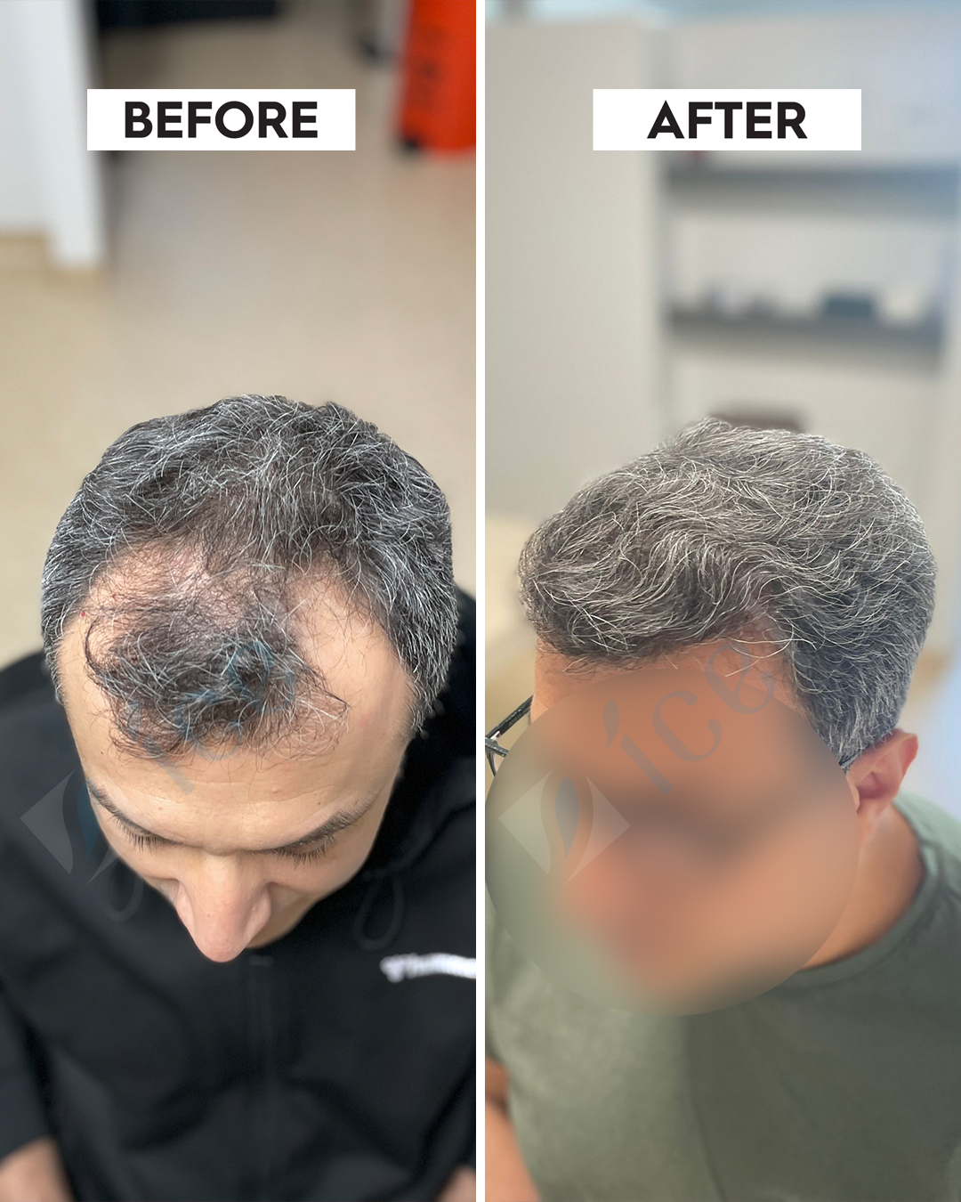 Hair Transplant Result 13