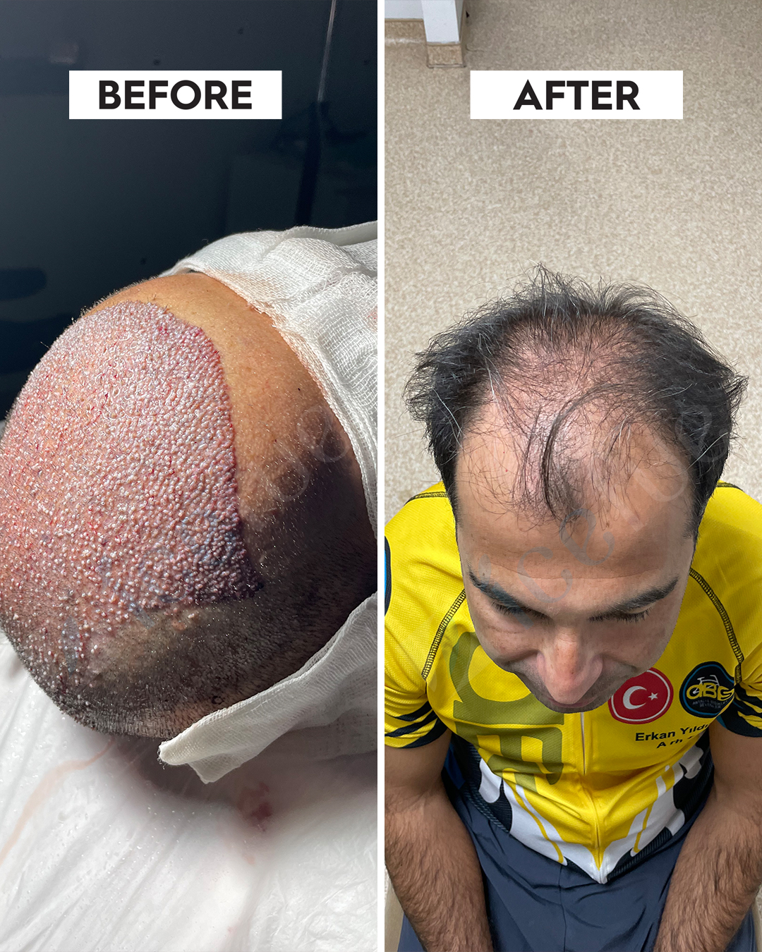 Hair Transplant Result 14