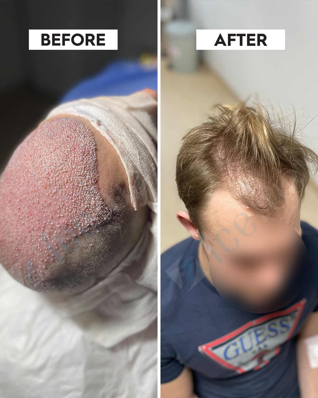 Hair Transplant Result 15