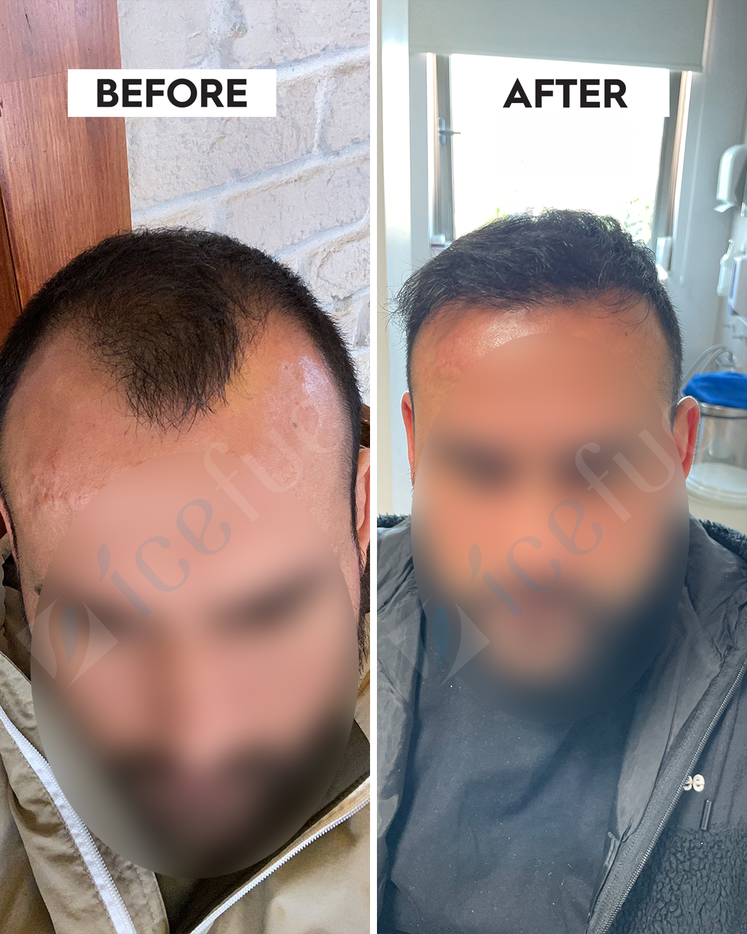 Hair Transplant Result 2