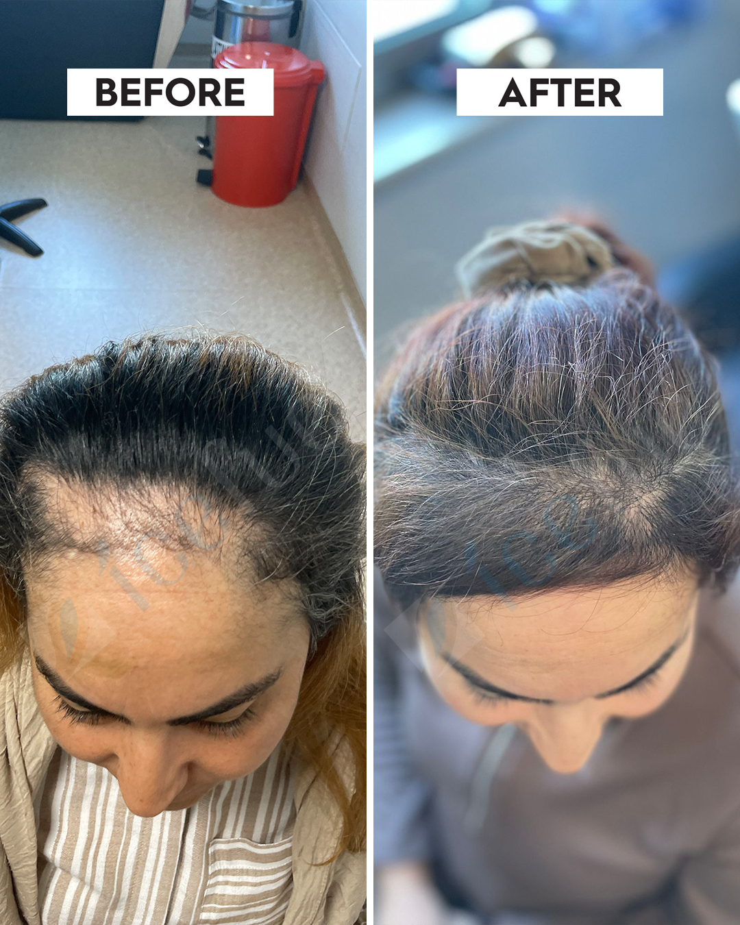 Hair Transplant Result 3