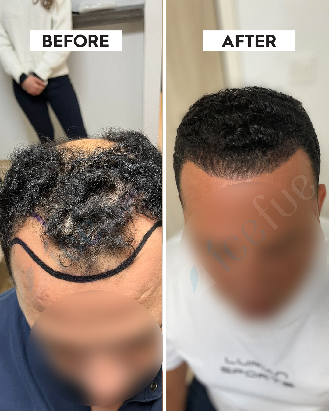 Hair Transplant Result 4