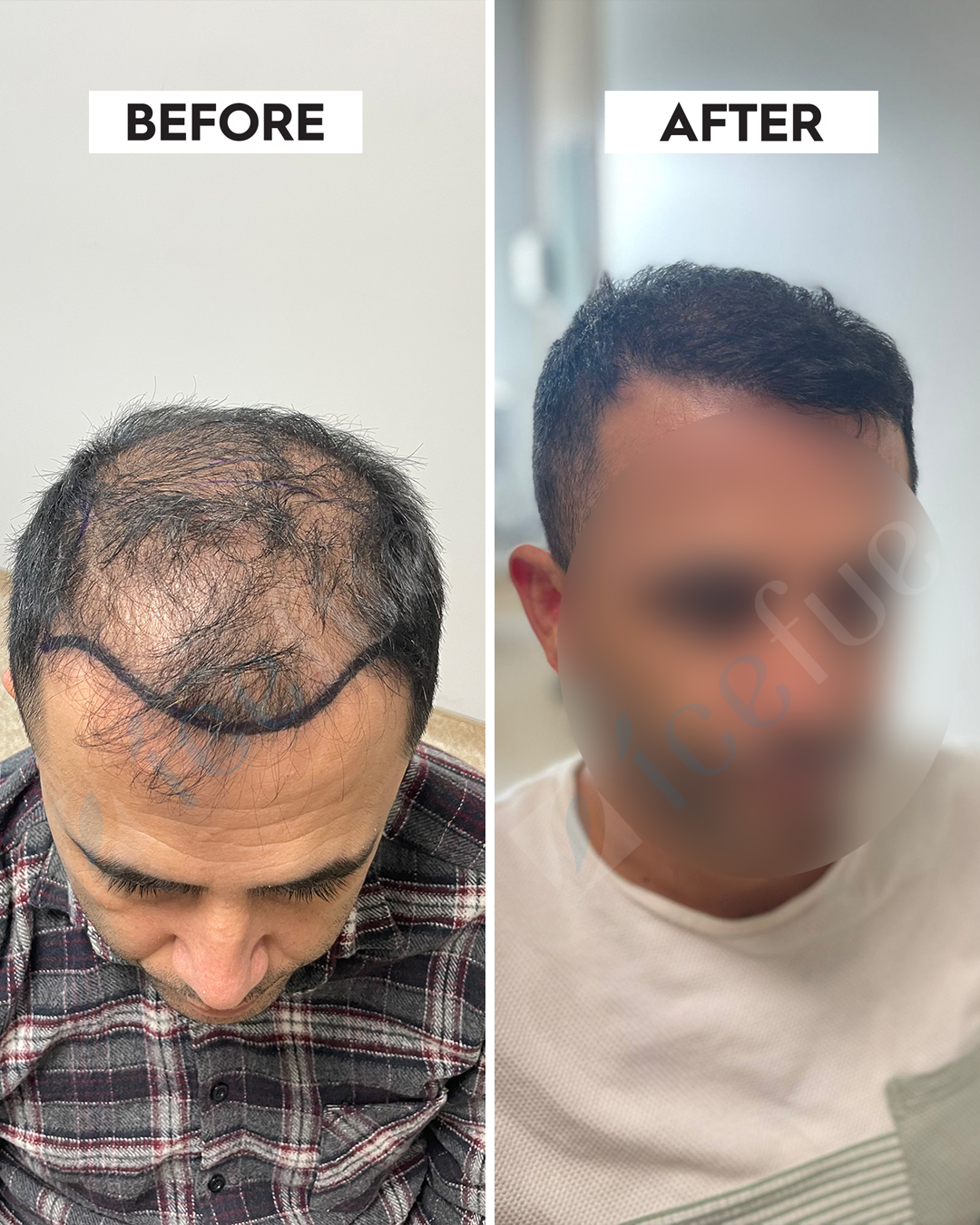 Hair Transplant Result 5
