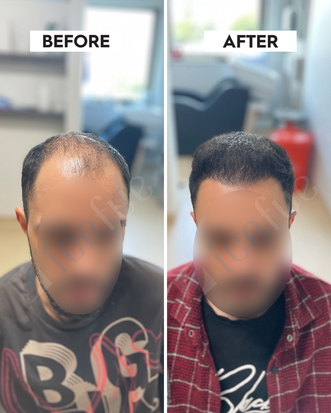 Hair Transplant Result 6