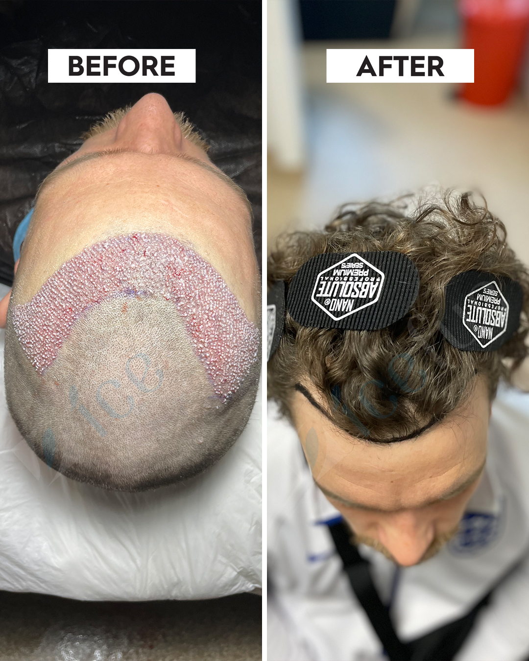 Hair Transplant Result 8