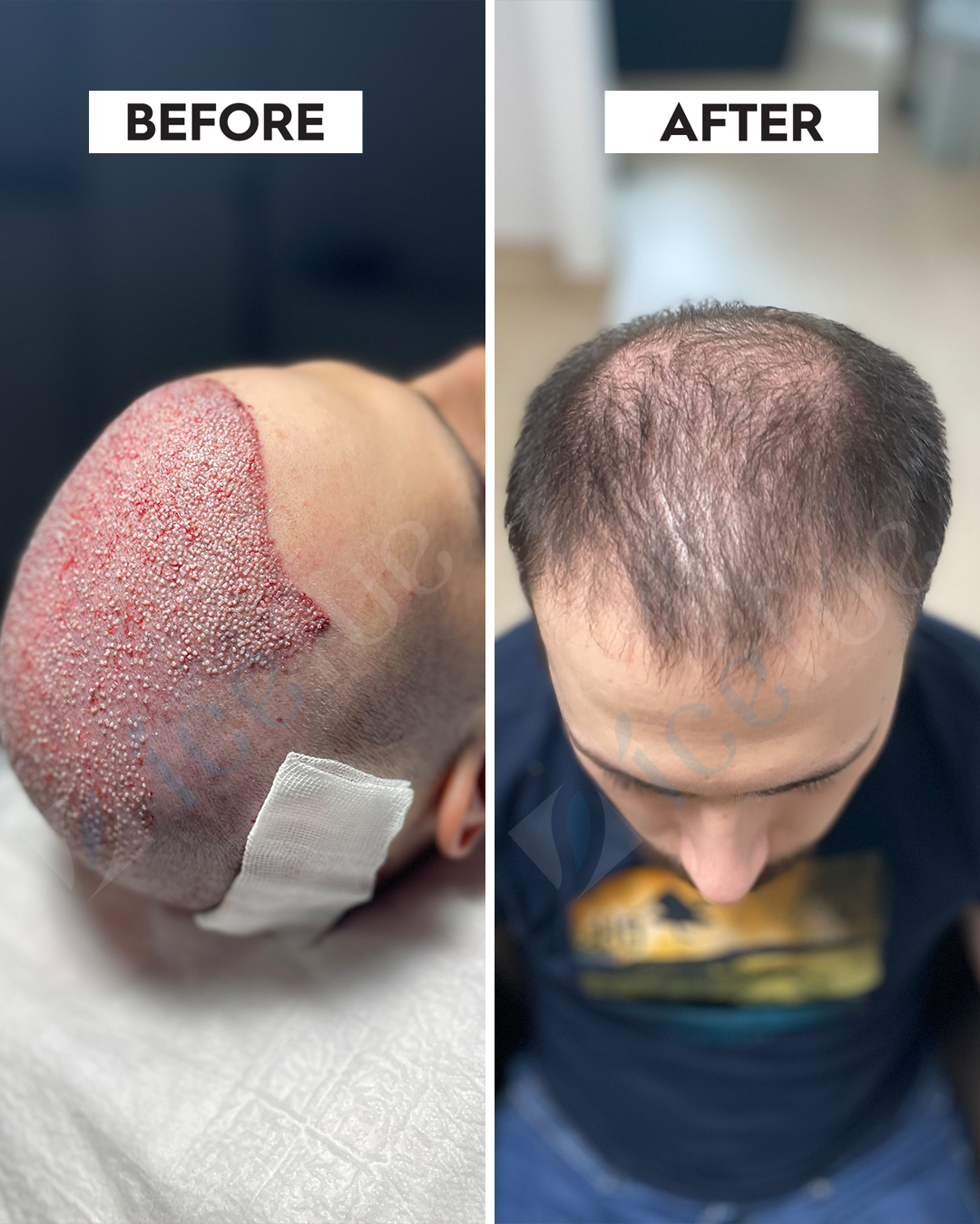 Hair Transplant Result 9