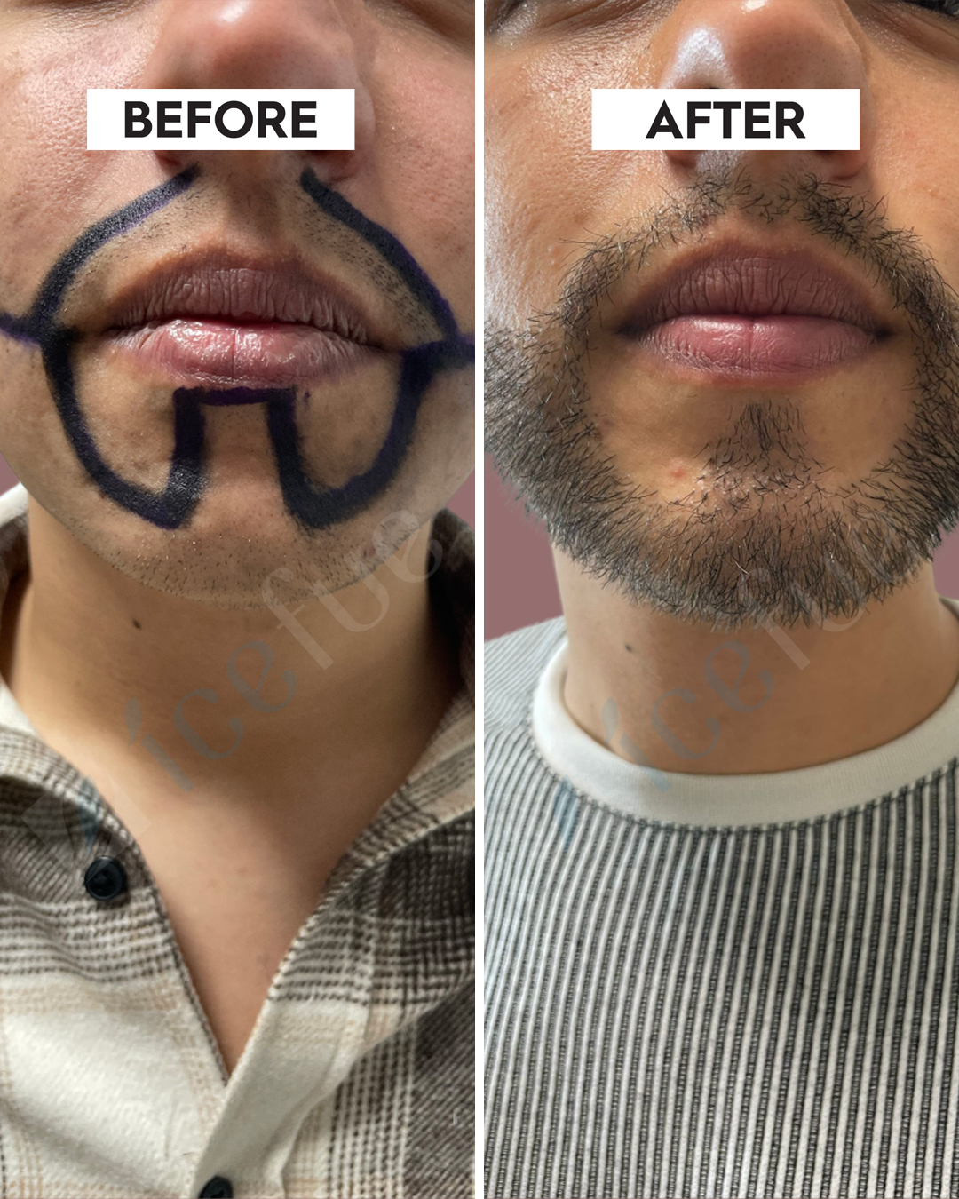 Natürliche Haarlinie